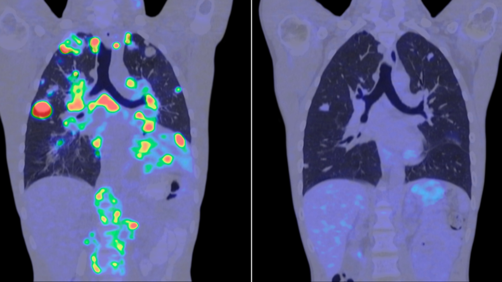 La inteligencia artificial abre una nueva etapa en la investigación contra el cáncer.