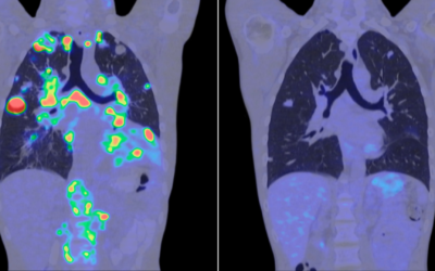 La inteligencia artificial abre una nueva etapa en la investigación contra el cáncer